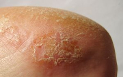 Jak vypadá kontaktní dermatitida