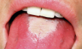 Hnědý povlak jazyka