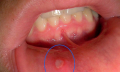 Afty v ústní dutině