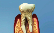 Parodontóza - skrytý strašák v ústech