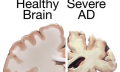 Alzheimerova choroba a další formy demence