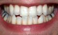 Citlivost zubů