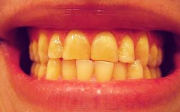 Žluté zuby