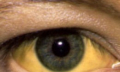 Žluté bělmo očí